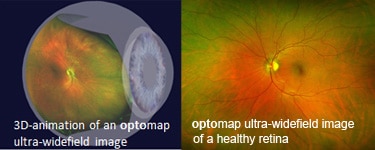 Corneal Topography Dallas TX