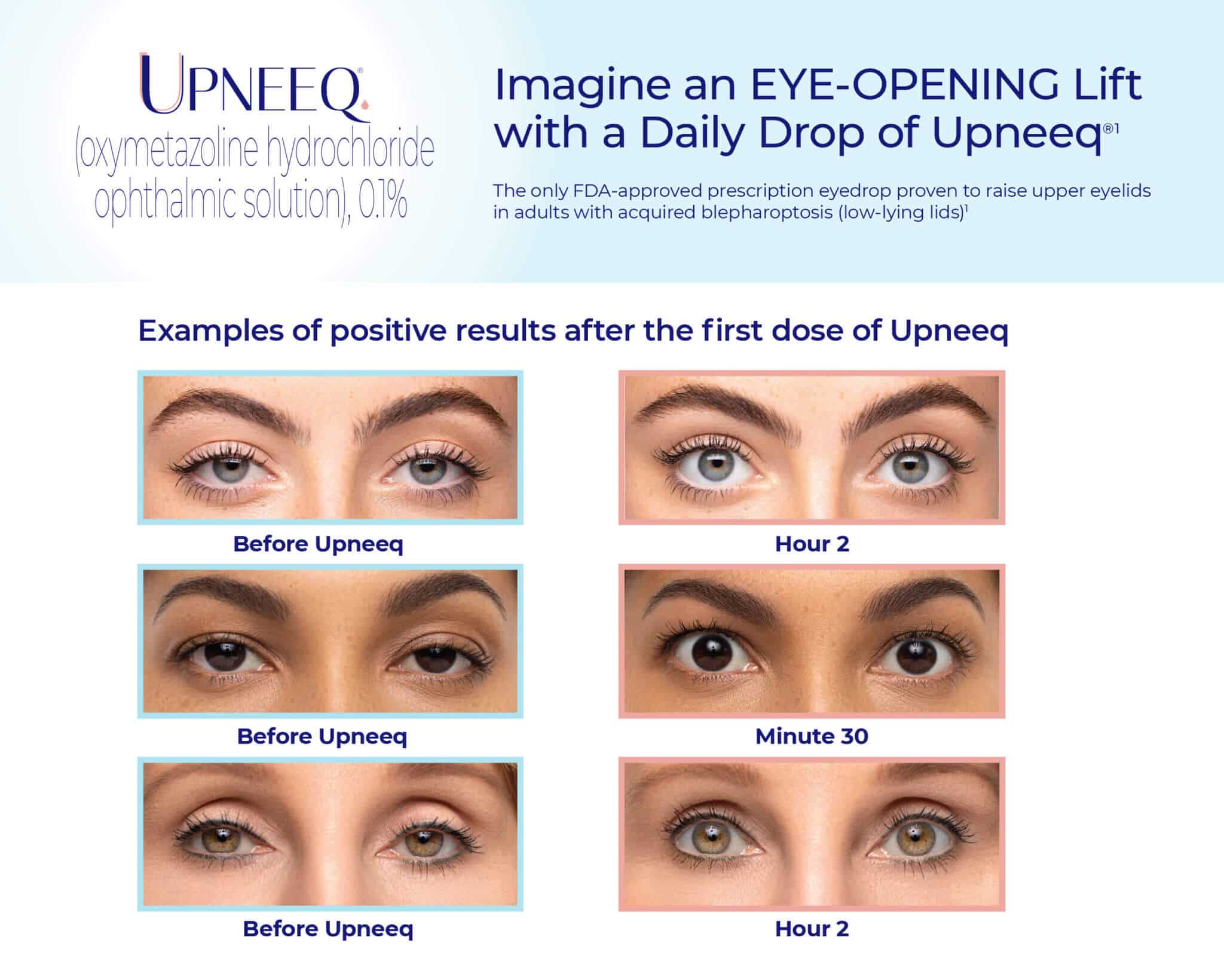 upneeq eye lift